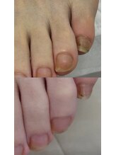 ドクターネイル爪革命 十条店/肥厚爪ケア