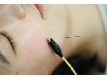 たたら鍼灸整骨院/電気を流す美容鍼