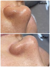 ニコリ(Nicori)/シェービングエステ