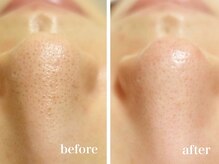 アユーナ(Ayu-Na)/毛穴の黒ずみ除去