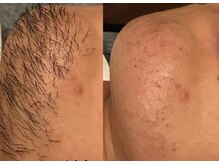 メモリー(memory)/ひげ脱毛【ビフォーアフター】