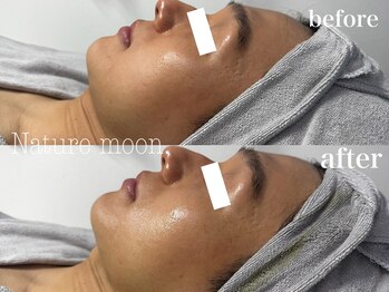 ナチュールムーン(Nature moon.)/ハーブピーリング