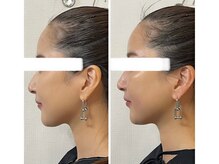 メディカルエース(MedicalAce)/【最強引き上げ】ハイサーマ