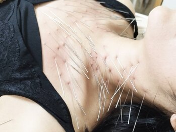 きやま鍼灸治療院の写真/全国でも希少なルート鍼施術は体の不調改善・美容目的に効果抜群♪体の構造を知り尽くした院長におまかせ◎