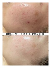 ルタンリッシュ さいたま店(Lutan Riche)/シミケアは根気強く続ける