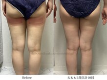 スラリ(SLARI)/【太もも　脂肪冷却】期間３ヶ月