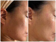 エイシスグロウ(asis glow.)/水光肌ララピール　効果写真