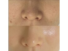 アリム(alim)/セラピールビフォーアフター