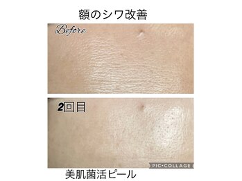 フリージア(Beauty Salon Freesia )/美肌菌活ピール2回目