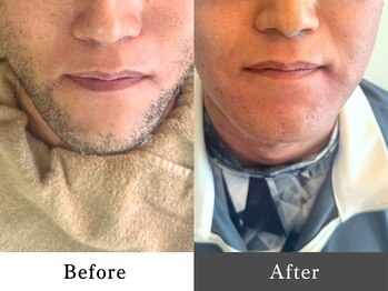 メンズオージー 岡山中区(men's O.G)/メンズ脱毛｜ひげ脱毛