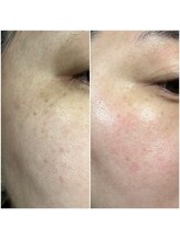 リアプア(Li'a)/お肌のシミやトーンアップにも◎