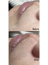 アールネイルズ(R Nails)/MinMin Wax脱毛