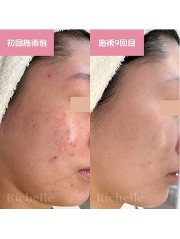 リシェル(Richelle)/ 【GREENPEELポアーズ】