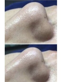 カラット ベル店(KARAT)/ハイドロ毛穴洗浄