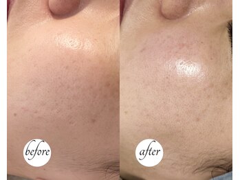 ルーム(lume)/ハーブピーリング before/after