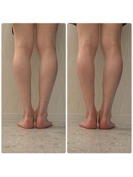 ソルニス(Solnis.)/痩身☆脂肪分解/ハイパーナイフ