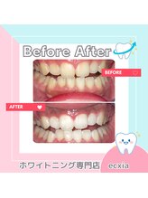 エクシアホワイトニング 札幌中島公園店/BeforeAfter［ホワイトニング］ 