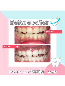 エクシアホワイトニング 札幌中島公園店/BeforeAfter［ホワイトニング］ 