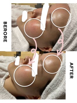 ポノ(PONO)/水光ピーリング