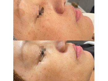 モルセラ(Moluccella)/9回の施術