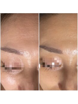 フロー(Flow)/ハーブピーリング