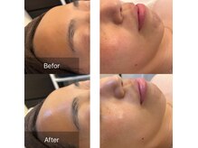 ☆美白/シミ/小じわ/毛穴/弾力/白玉肌☆ホワイトスノーピール