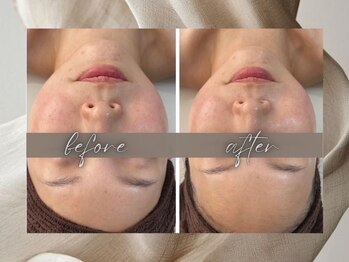 ゴールデンケア(goldencare)/お悩み【全顔縮小】大満足です！