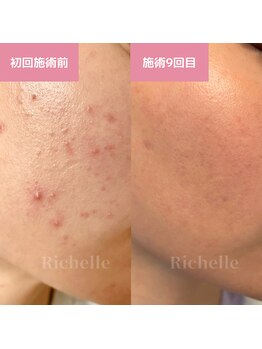 リシェル(Richelle)/ 【GREENPEEL5days】