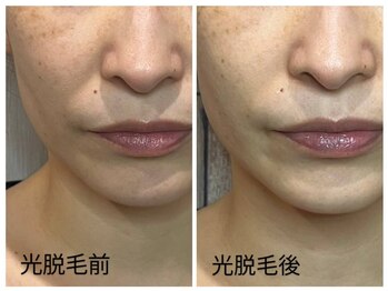 ボリスビアン プリンシェ(Borisvian Prinche)/人気NO.1　顔脱毛