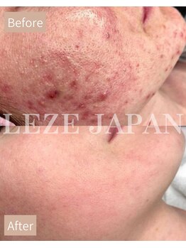 ルーナ 恵比寿(Luna)/優しい酸でまず肌環境を整えます