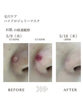 サロン エイトミー(salon 83)/【毛穴ケア】ニキビケア