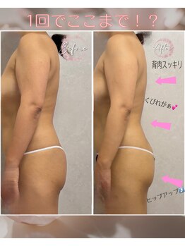 カシェボーテ(CACHE BEAUTE)/たった一回で薄くなった背中