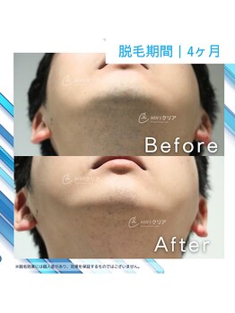 メンズクリア フィール 旭川店/【メンズクリア】お客様の施術例