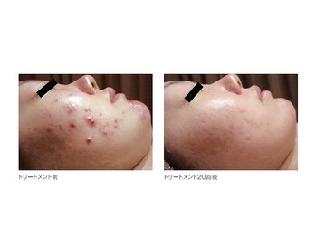 ウル(Ulu)/水光ピーリングでニキビケア★