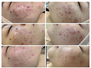 エスティ 京都店/ニキビケア経過