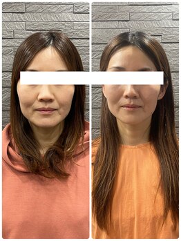 長寿鍼灸院 長寿整骨院/ハリネズミ女優美容鍼効果★