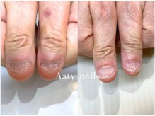 アーティネイルズ(Aaty Nails)/【深爪矯正】ハンド