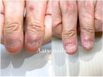 【深爪矯正】ハンド