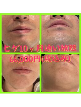 リアンジュ/ヒゲ脱毛の経過