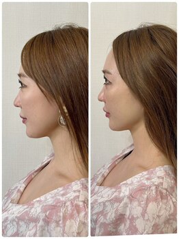 メディカルエース(MedicalAce)/【最強引き上げ】ハイサーマ