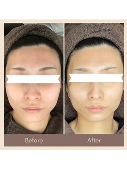 マックス(MAX)/たるみ改善/リフトアップ効果