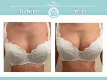 美人バスト 小倉店/バストアップ◇症例◇