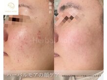 リンクプラスビューティー(RiMK plus beautY)/長年の悩み、無かった事に！