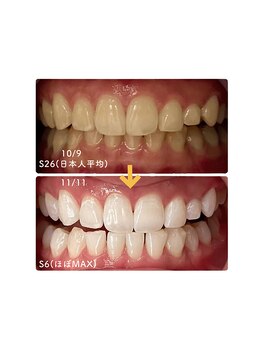 グロウ 東区香椎(GLOW)の写真/通常サロンにない！美容ホワイトニングより持続3-6倍&透明感UPの歯科提携ジェルホワイトニングで根本解決◎