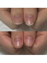 セラキュアネイル(Theracure nail)/2ヶ月で自爪が整ってます。