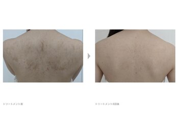 ビューティーサロンレモン(Lemon)/背中ピーリング