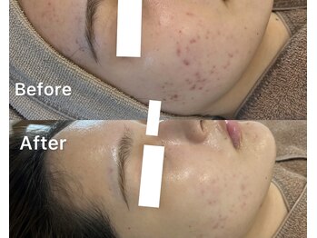 プティ 横浜店(Petit)/韓国式ハーブピーリング