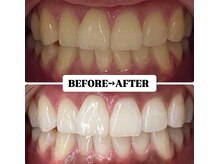 ホワイトニングサロン 宝塚/Before&After美白ホワイトニング