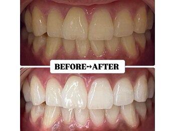 ホワイトニングサロン 宝塚/Before&After美白ホワイトニング