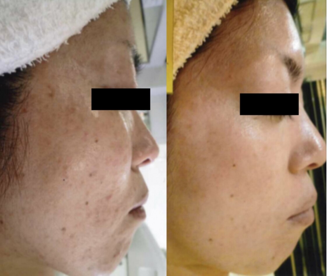 【くすみ,しみ改善】贅沢9STEP★(生コラ＋MC2X・銅ペプチド+選べるケア)\5500